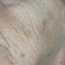 laser-estetica1