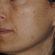 laser-estetica2