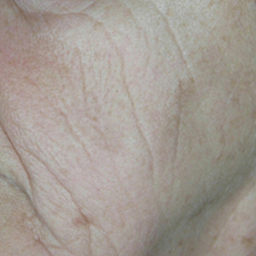 laser-estetica2